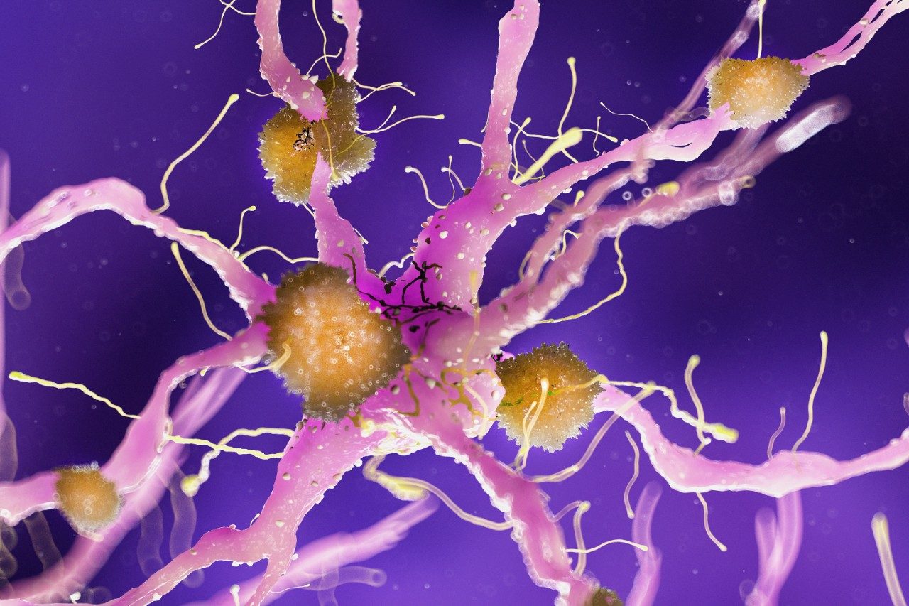 Amyloid plaques on a alzheimer nerve cell