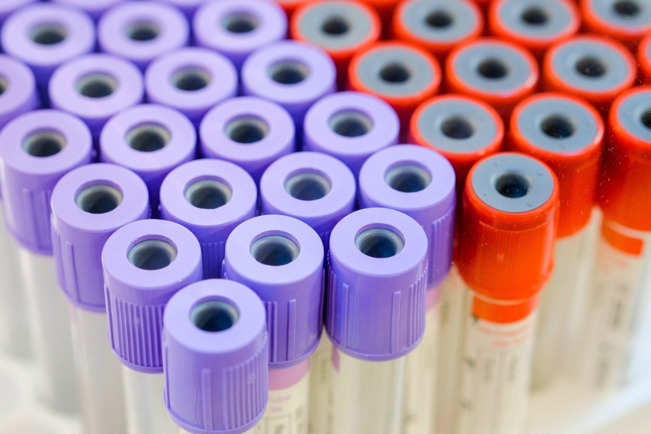 Medical blood plasma sample tubes in clinical lab