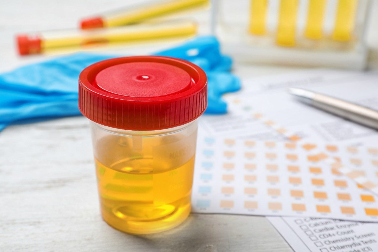 Urine sample cup on table with test strips