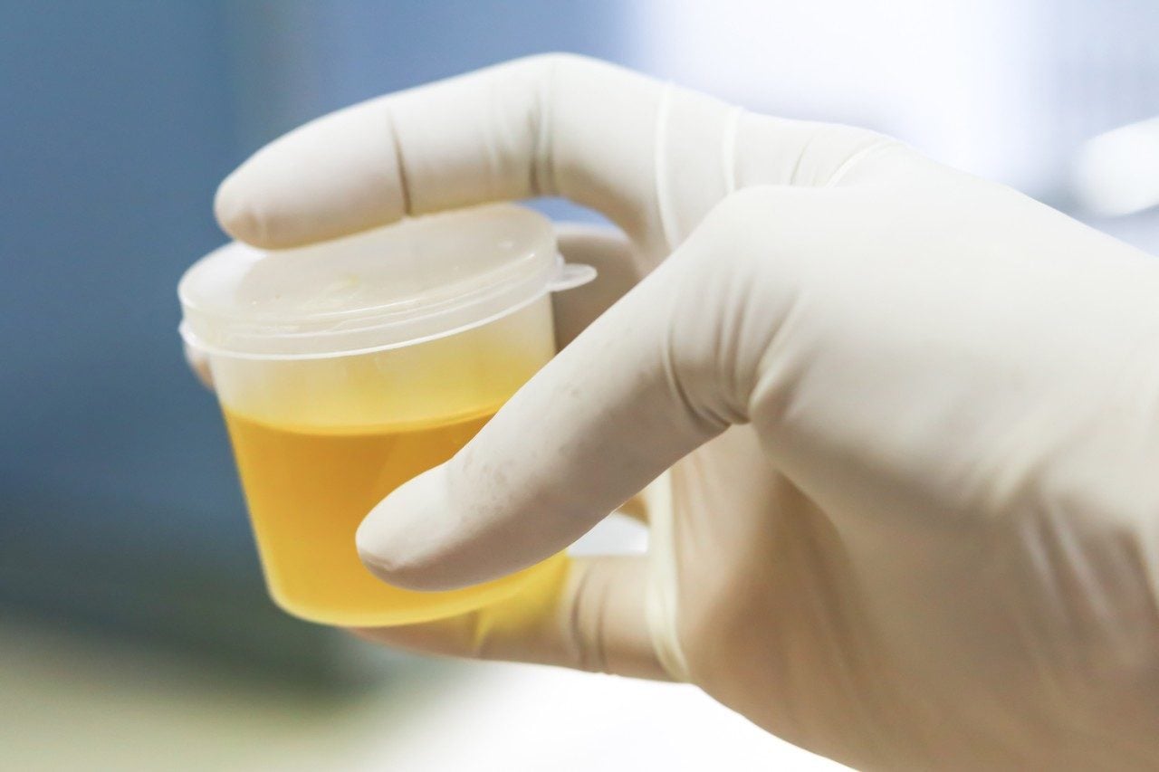 Gloved hand holding urine sample