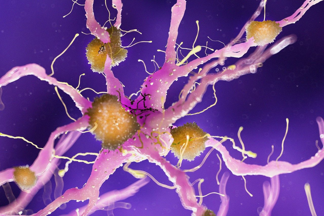 Amyloid plaques on alzheimer nerve cell