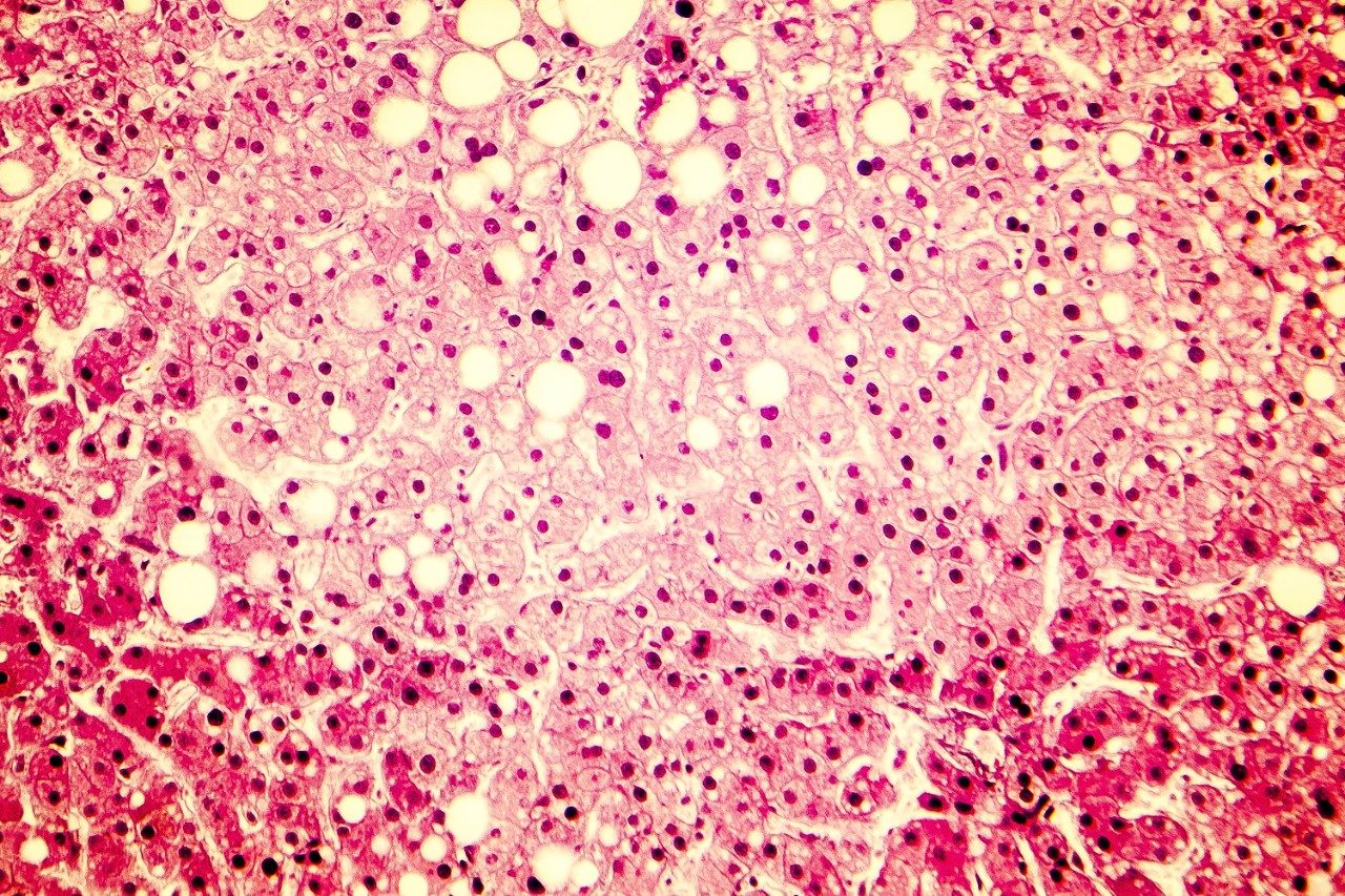 Light micrograph of a fatty liver