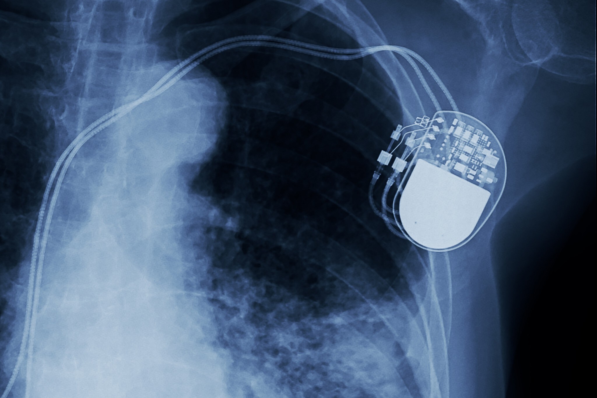 Radiografia dell’impianto di un pacemaker nel corpo toracico